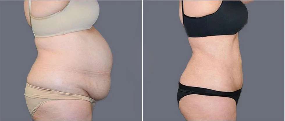 mega vaser liposcution female pre2024 002 before and after before and after