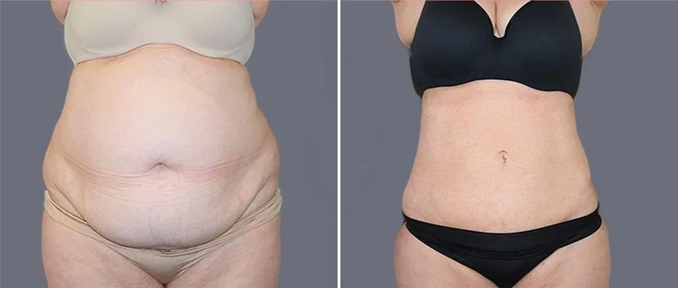mega vaser liposcution female pre2024 003 before and after before and after