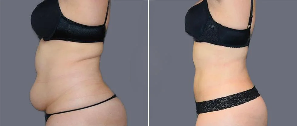 mega vaser liposcution female pre2024 005 before and after before and after