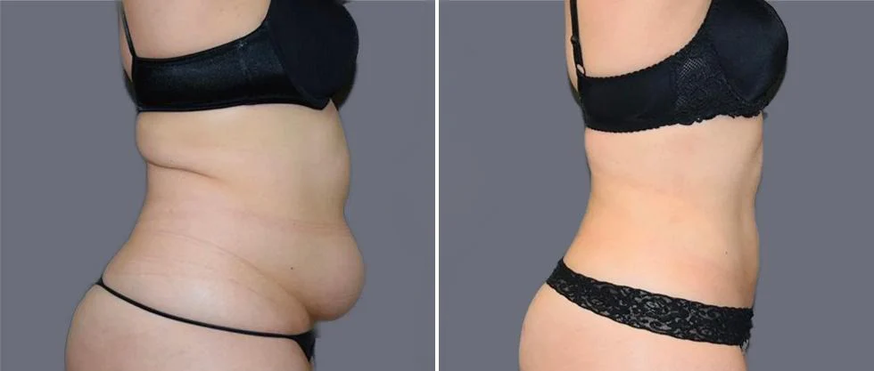 mega vaser liposcution female pre2024 007 before and after before and after