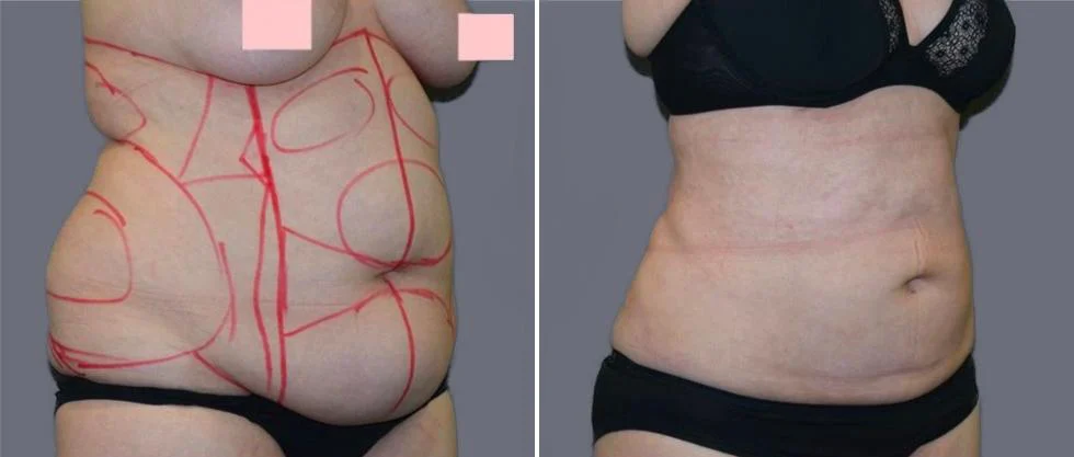 mega vaser liposcution female pre2024 008 before and after before and after