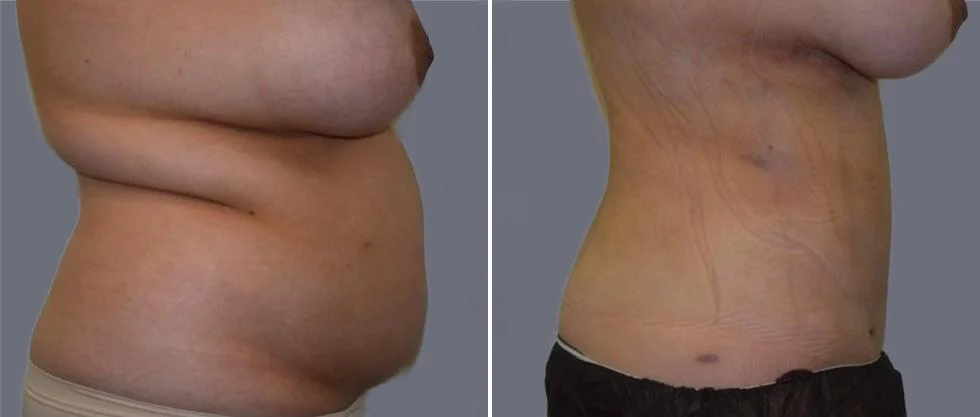 mega vaser liposcution female pre2024 015 before and after before and after