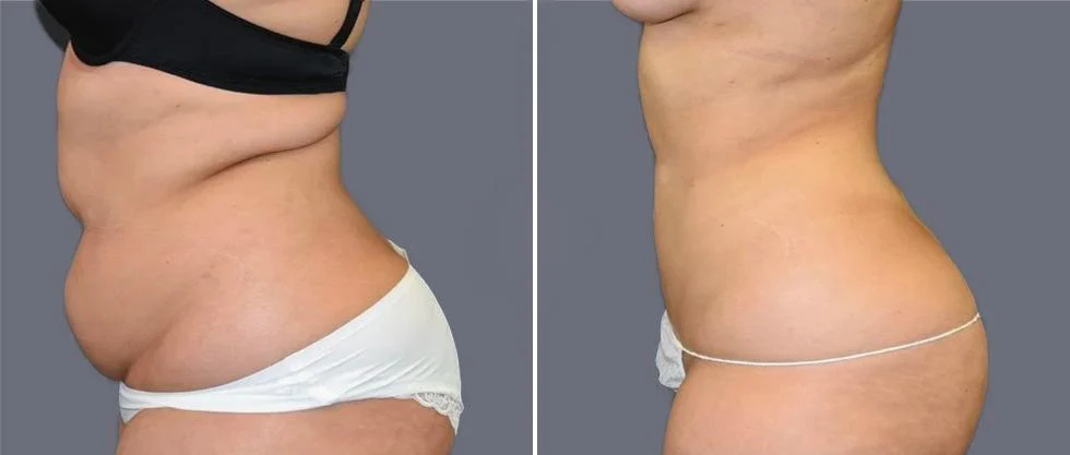 mega vaser liposcution female pre2024 016 before and after before and after
