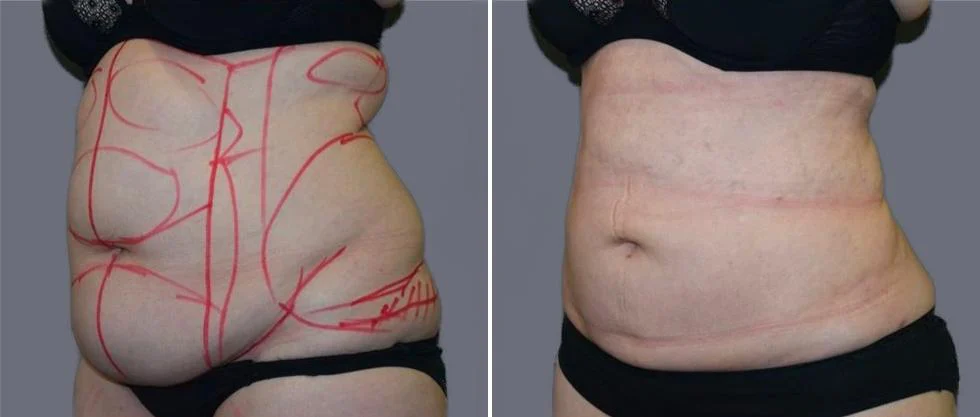 Before and after liposuction.