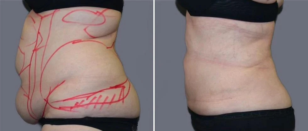 mega vaser liposcution female pre2024 018 before and after before and after