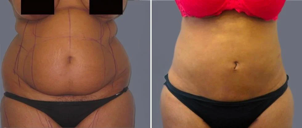 mega vaser liposcution female pre2024 020 before and after before and after
