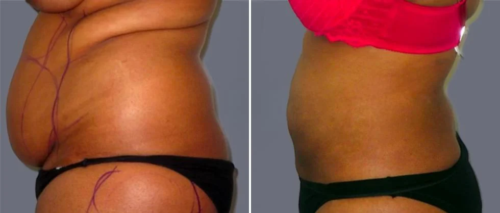mega vaser liposcution female pre2024 021 before and after before and after