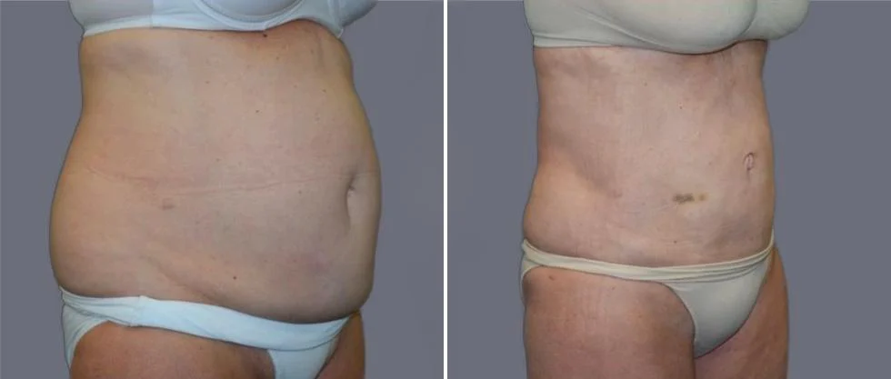 mega vaser liposcution female pre2024 028 before and after before and after