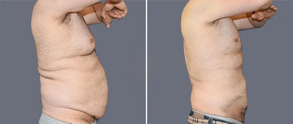 mega vaser liposcution male pre2024 010 before and after before and after