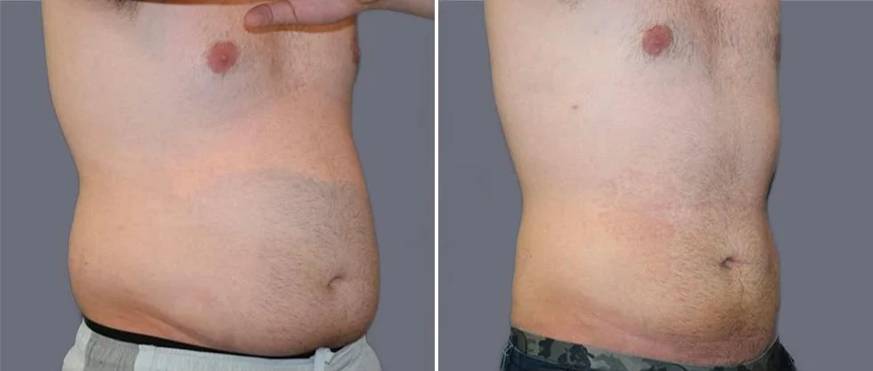 mega vaser liposcution male pre2024 012 before and after before and after