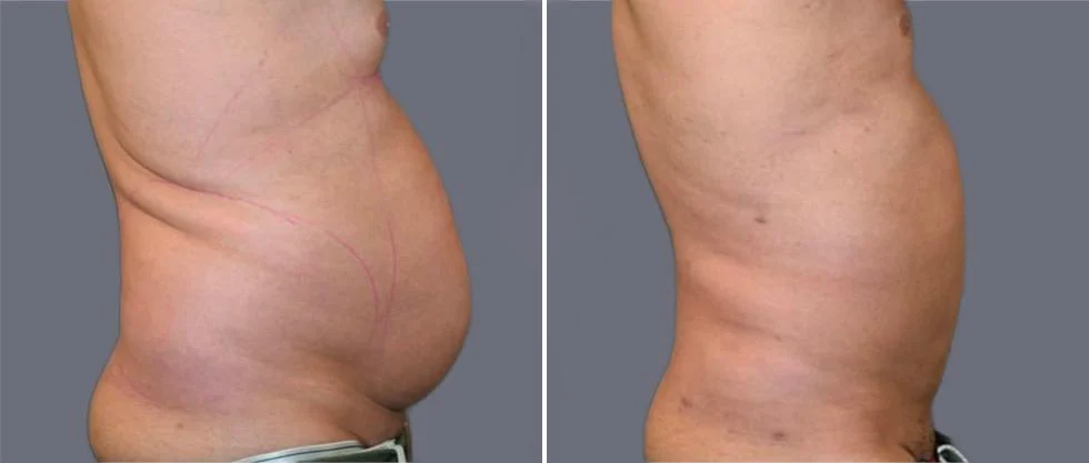 mega vaser liposcution male pre2024 013 before and after before and after