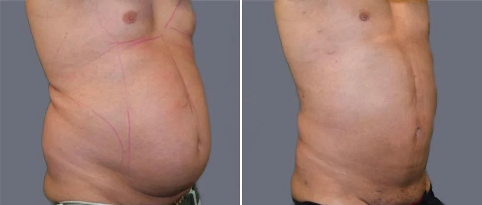 mega vaser liposcution male pre2024 014 before and after before and after