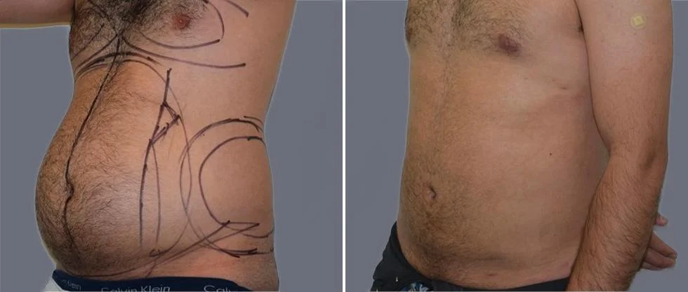 mega vaser liposcution male pre2024 022 before and after before and after