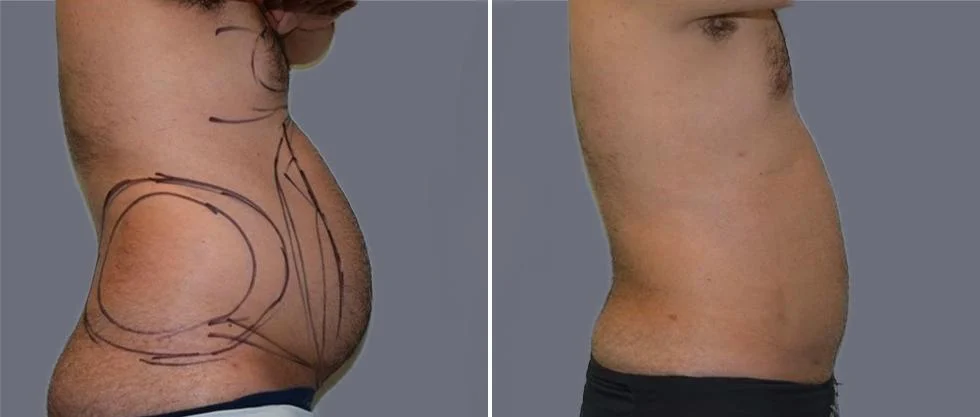 mega vaser liposcution male pre2024 023 before and after before and after