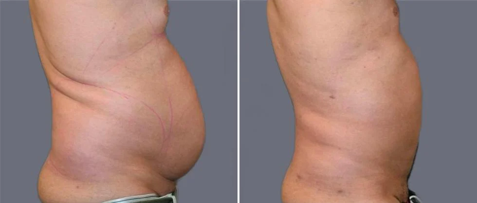 mega vaser liposcution male pre2024 027 before and after before and after