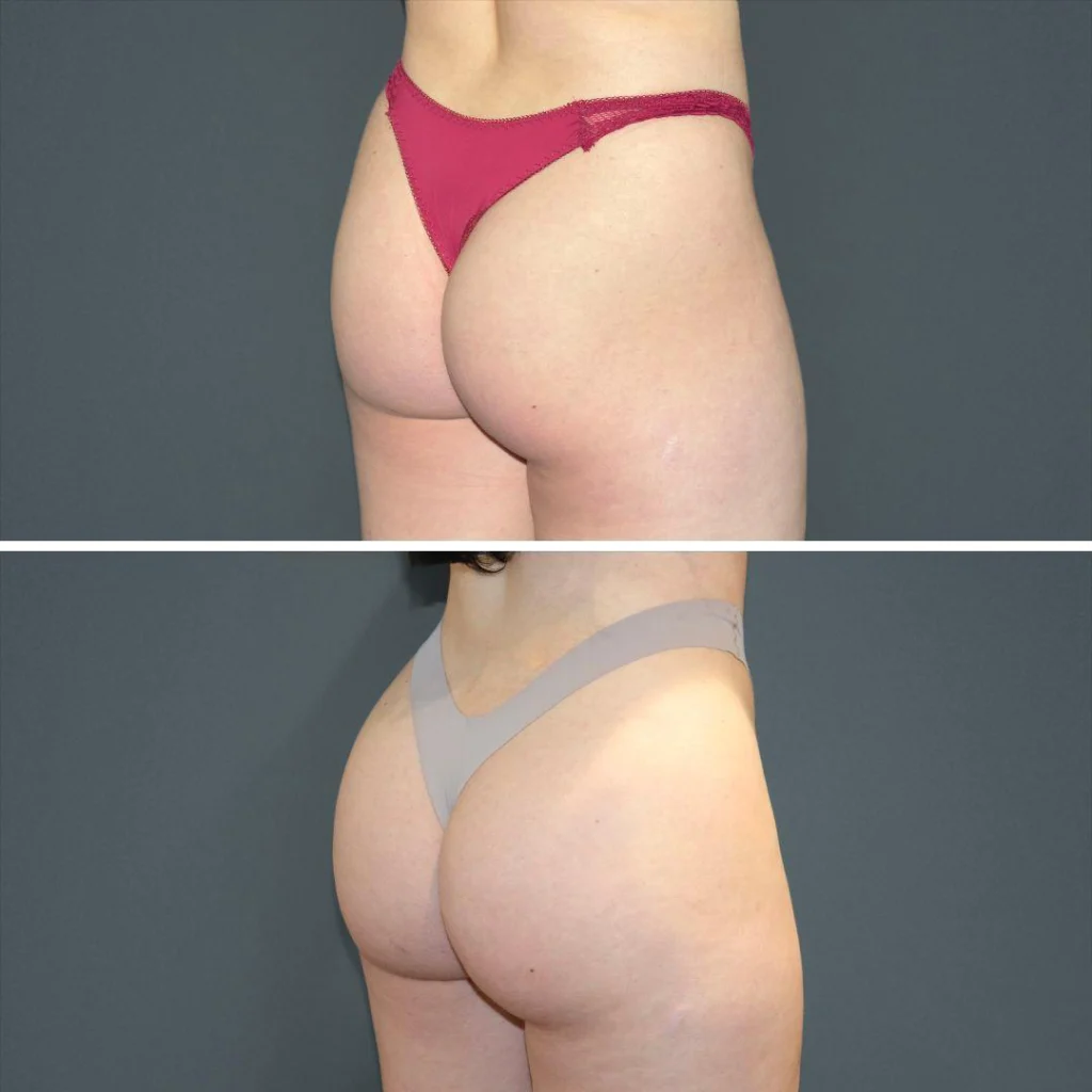 sydney bbl butt female 2022 right vk before and after before and after