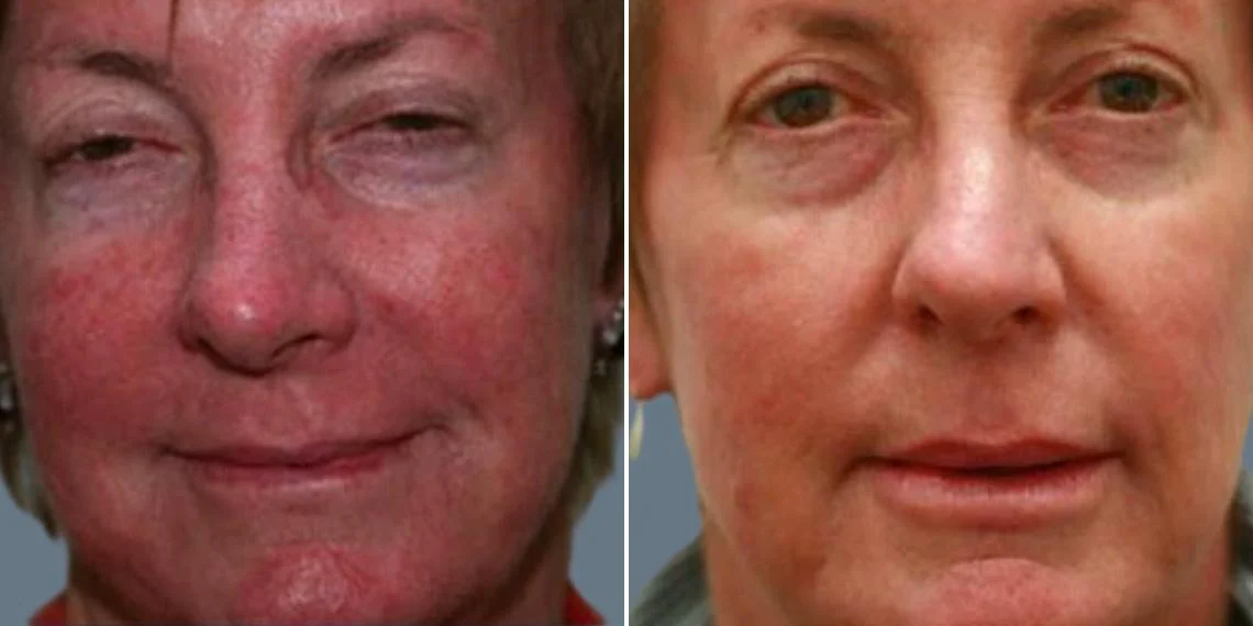 Capillaries & Rosacea Before & After before and after at Cosmos Clinic