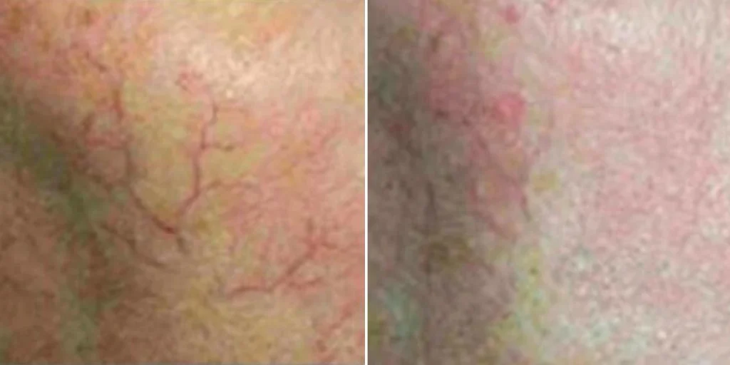skin acne capillaries rosacea female pre2024 003 before and after before and after