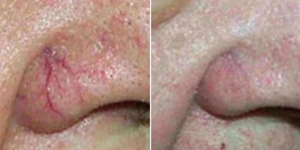 skin acne capillaries rosacea female pre2024 004 before and after before and after