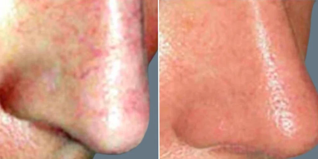 Before and after rosacea capillary treatment of the skin.