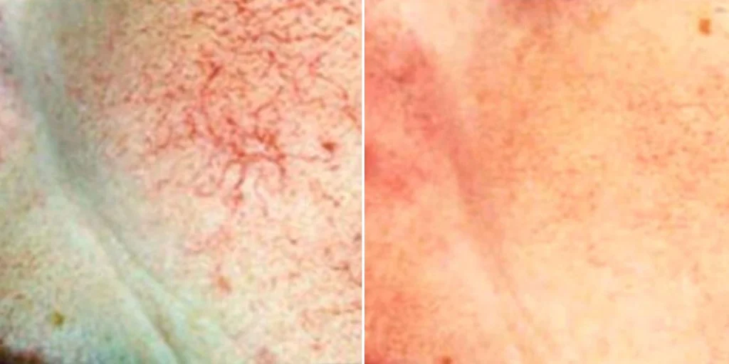 skin acne capillaries rosacea female pre2024 006 before and after before and after