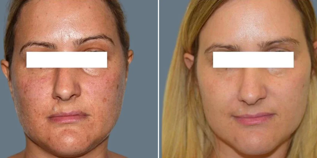before and after