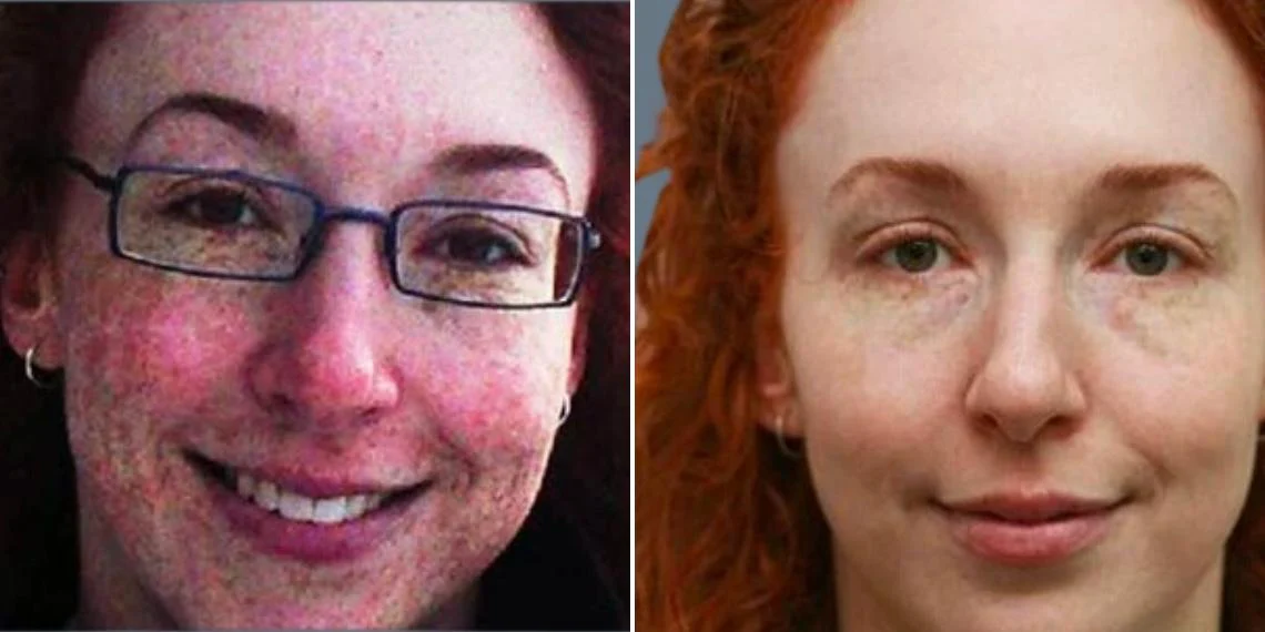 Pigmentation Before & After before and after at Cosmos Clinic
