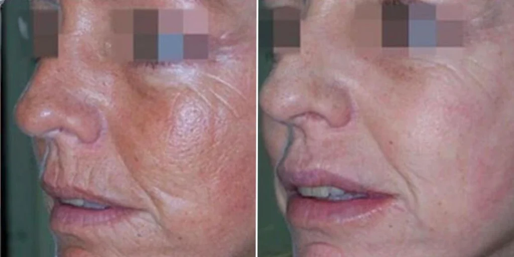 skin acne pigmentation scars female pre2024 005 before and after before and after