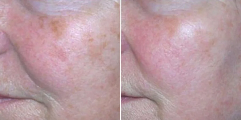 skin acne pigmentation scars female pre2024 006 before and after before and after