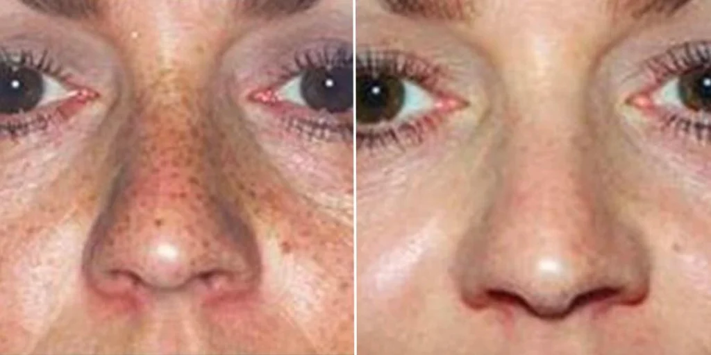 skin acne pigmentation scars female pre2024 007 before and after before and after