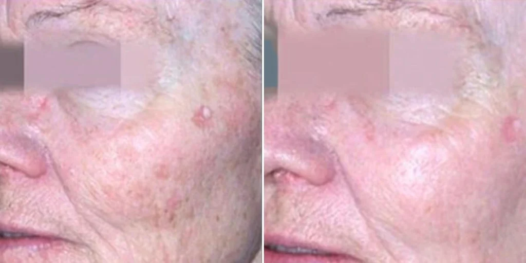 skin acne pigmentation scars female pre2024 009 before and after before and after