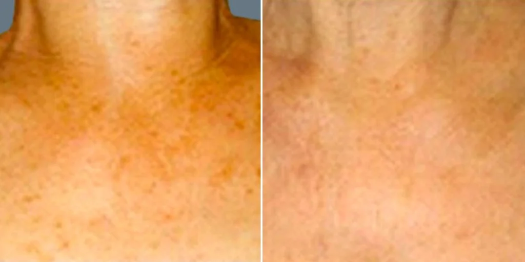 skin acne pigmentation scars female pre2024 010 before and after before and after
