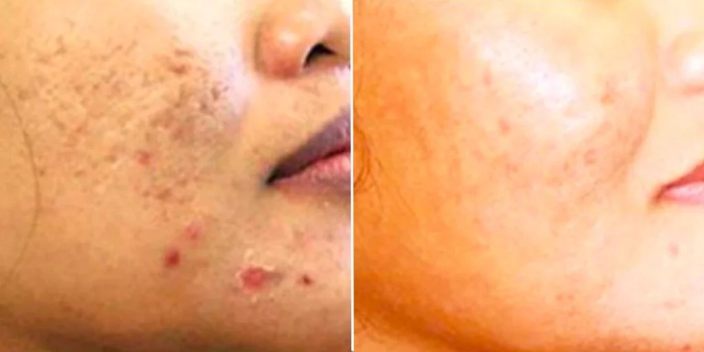 skin acne scars female pre2024 001 before and after before and after
