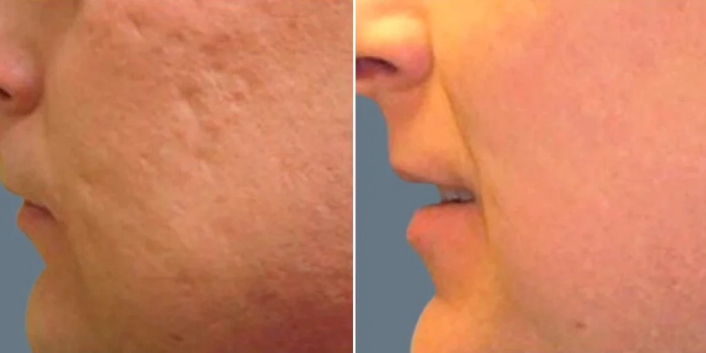 skin acne scars male pre2024 003 before and after before and after