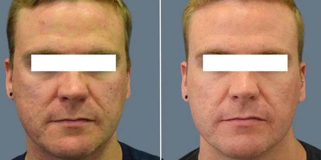skin acne skin needling male pre2024 002 before and after before and after