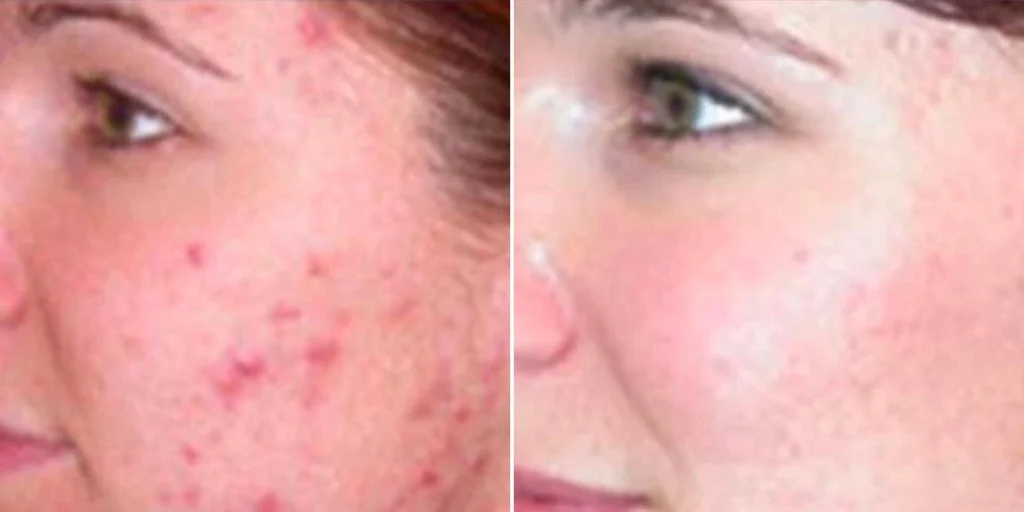 skin acne treatment female pre2024 002 before and after before and after