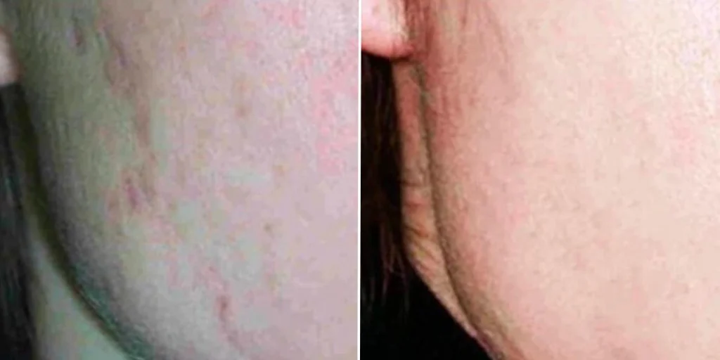 Acne Consultations before and after at Cosmos Clinic