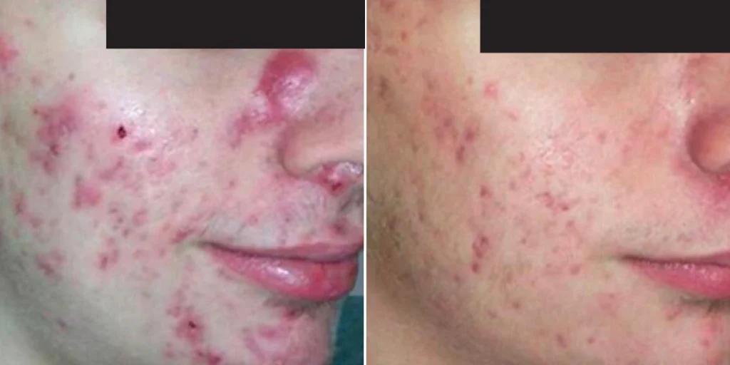 skin acne treatment male pre2024 004 before and after before and after