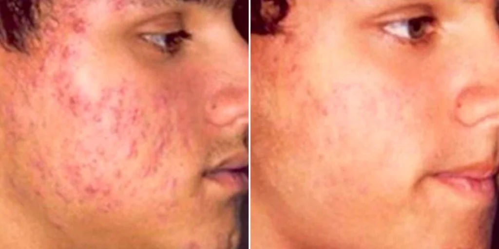 skin acne treatment male pre2024 005 before and after before and after