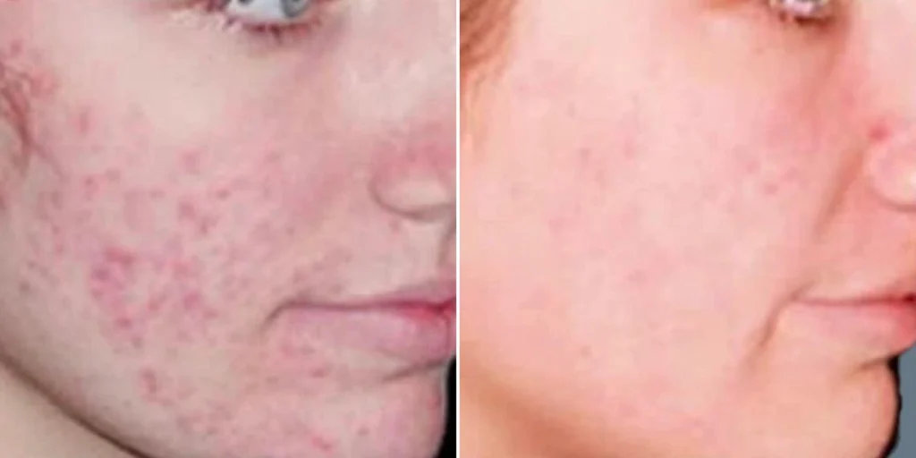 skin acne treatment male pre2024 006 before and after before and after