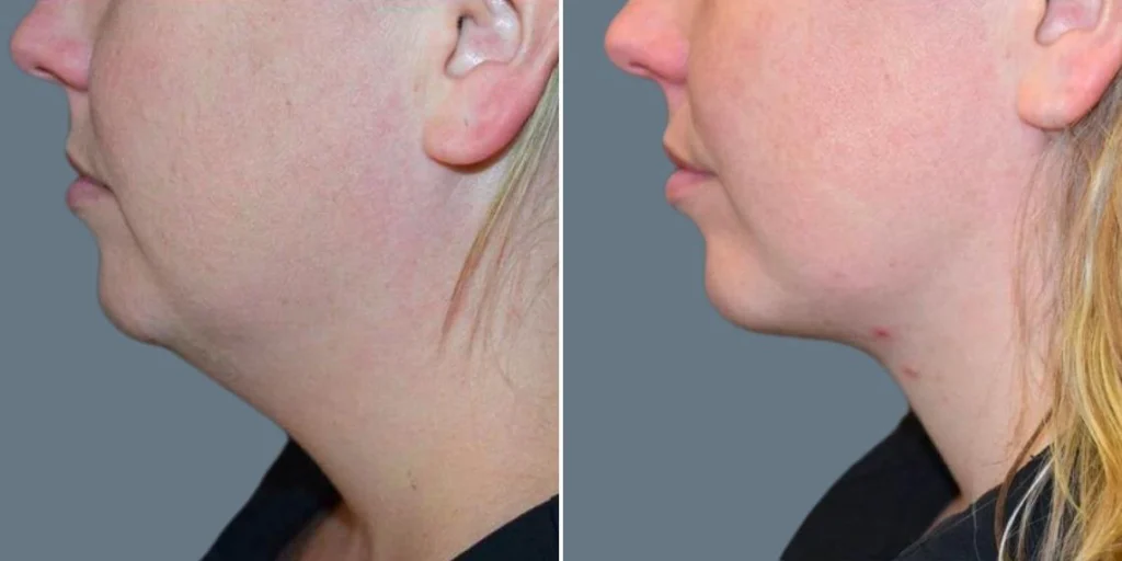 skin neck liposuction lift female pre2024 001 before and after before and after