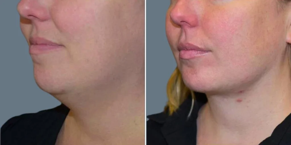 skin neck liposuction lift female pre2024 002 before and after before and after