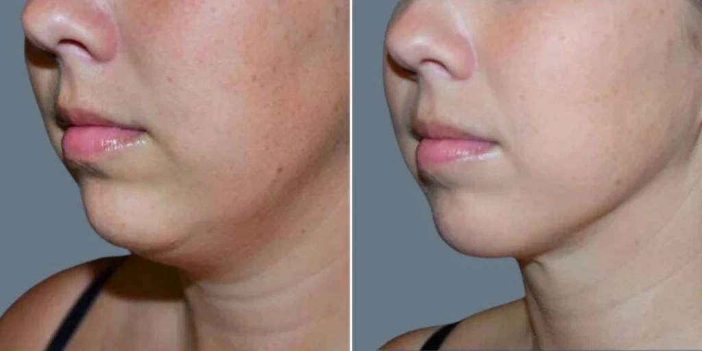 skin neck liposuction lift female pre2024 003 before and after before and after