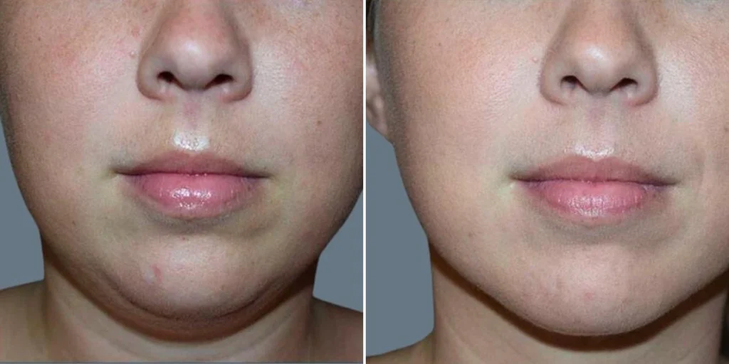 skin neck liposuction lift female pre2024 004 before and after before and after