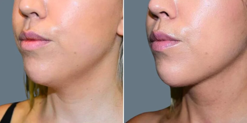 skin neck liposuction lift female pre2024 005 before and after before and after