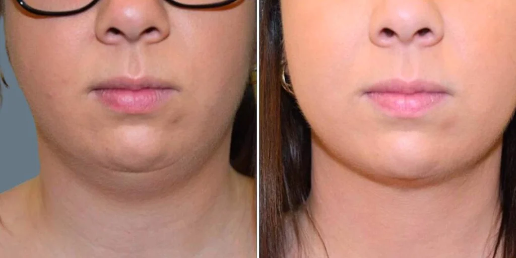 skin neck liposuction lift female pre2024 006 before and after before and after