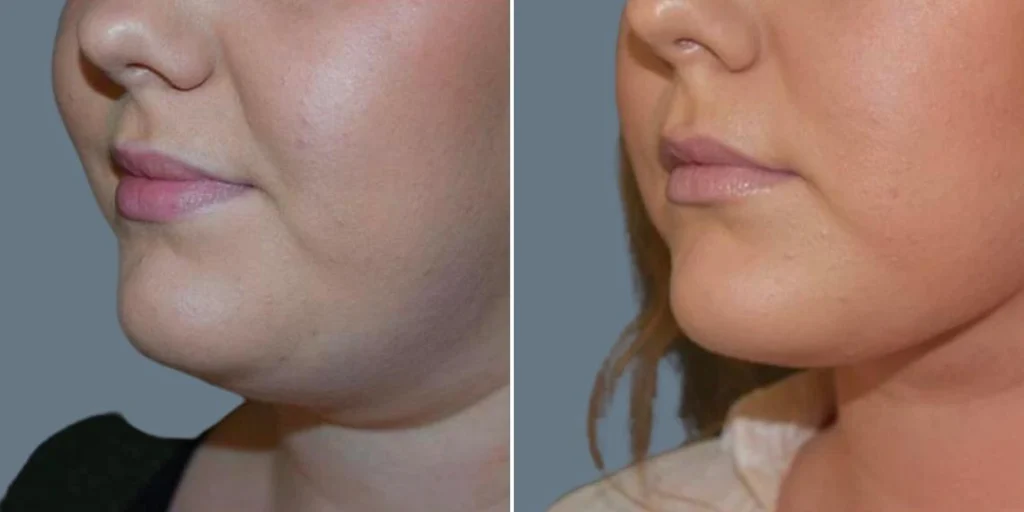 skin neck liposuction lift female pre2024 008 before and after before and after