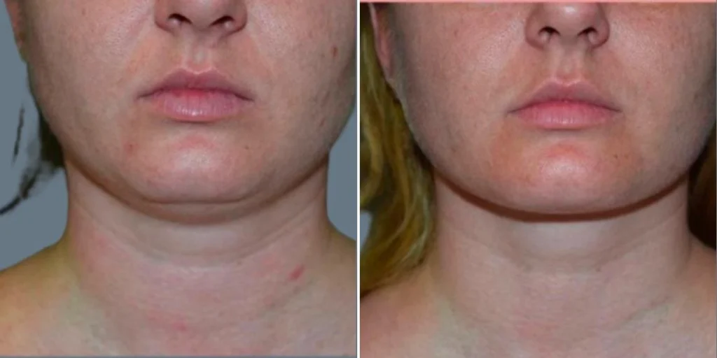 skin neck liposuction lift female pre2024 012 before and after before and after