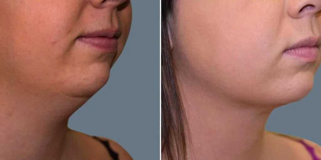skin neck liposuction lift female pre2024 014 before and after before and after