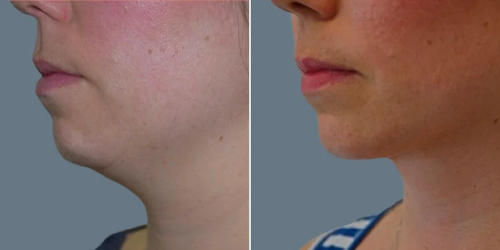 Before and after liposuction of the neck.